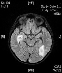 CNS TOXOPLASMOSIS POST HSCT