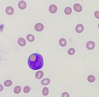 Erythrophagocytosis in B cell acute Lymphoblastic Leukemia.