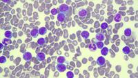 Adult T-cell leukemia/lymphoma (marrow)