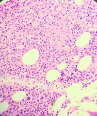 BONE MARROW BIOPSY 2