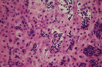 Liver biopsy: Hepatic extramedullary hematopoeisis