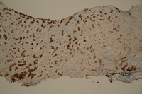 Immunohistochemical staining positive for the erythroid marker, CD 71