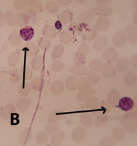 Plasmodium vivax  amoeboid and schizont forms in PBS 3