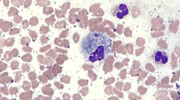 Peripheral blood smear shows a circulating histiocyte