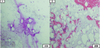 Gelatinous transformation of bone marrow