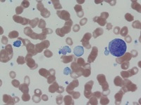 Megakaryoblast with abnormal platelets