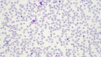 Beta-thalassemia major