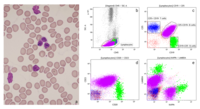 Bi-Clonal CLL