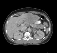 Figure 1: CT Abdomen