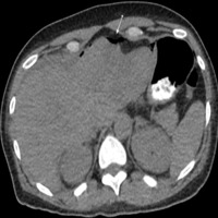 Figure 3. CT abdomen