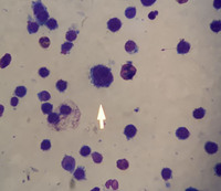 AML-M7 category with micro-megakaryocytes 5