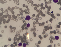 AML-M7 category with micro-megakaryocytes 6