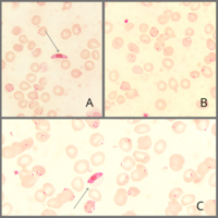 Plasmodium falciparum and Babesia: Importance of thin-film examination for morphological differentiation of Babesia and Plasmodium falciparum