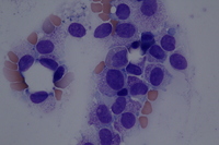 Neoplastic mast cells in bone marrow aspirate (Wright-Giemsa stain)