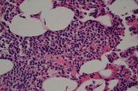 Mast cell nodule with sclerotic focus