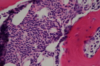 Spindle-shaped mast cells in Systemic Mastocytosis