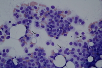 Neoplastic Mast cells in bone marrow aspirate