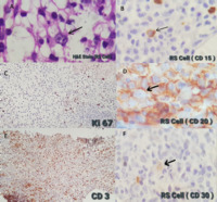 A Case of Classical Hodgkin Lymphoma with Pancytopenia