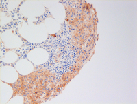 CD25 in systemic mastocytosis