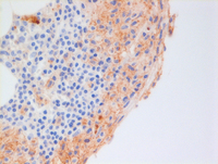 CD25 systemic mastocytosis