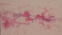 Nocardia Microscopy AFB stain