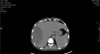 CT Abdomen - Liver Abscess