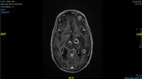 Nocardia Brain Abscess - MRI Brain