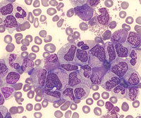 Bone Marrow Aspirate