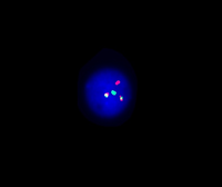 zoom picture Fluorescence in situ hybridisation (FISH) of BCR-ABL1 fusion