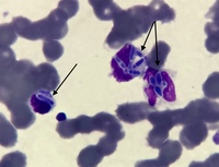 Fungal Inclusions in cytoplasm of white blood cells 1