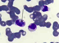 Fungal Inclusions in cytoplasm of white blood cells 2