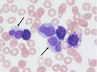 Basophilia in Chronic Myelogenous Leukemia