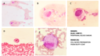 Cytomegalovirus- lnfected large, atypical Cells in Peripheral Blood Films of Immunosuppressed Patient