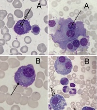 DUTCHER VERSUS RUSSELL BODIES IN PLASMA CELLS