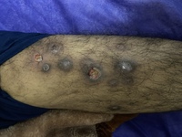 Leg ulcer complication in sickle cell patient. 1