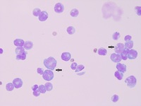 Adult T-cell Leukemia/Lymphoma with CNS involvement 1