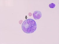 Adult T-cell Leukemia/Lymphoma with CNS involvement 2