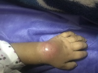 Dactylitis (hand foot syndrome)