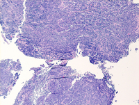 Dutcher Bodies in Lymphoplasmacytic Lymphoma 1