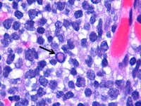 Dutcher Bodies in Lymphoplasmacytic Lymphoma 2