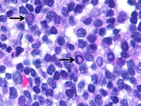 Dutcher Bodies in Lymphoplasmacytic Lymphoma 3