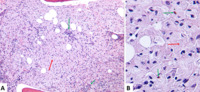 Crystal-Storing Histiocytosis Masking a Plasma Cell Neoplasm
