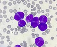 Acute Promyelocytic Leukemia, variant