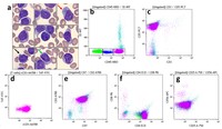 T-PLL with heterogeneous CD45 expression