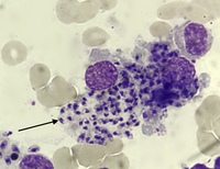 Leishmania amastigote in bone marrow