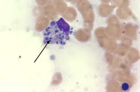 Histoplasma capsulatum in bone marrow