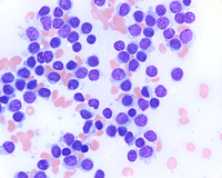 Bone-marrow-aspirate