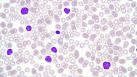 Mantle cell lymphoma