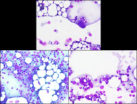 Atypical megakaryocytes