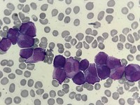 Acute Promyelocytic Leukemia Hypogranular Variant